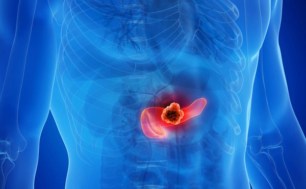 Progressão no combate ao cancro de pâncreas