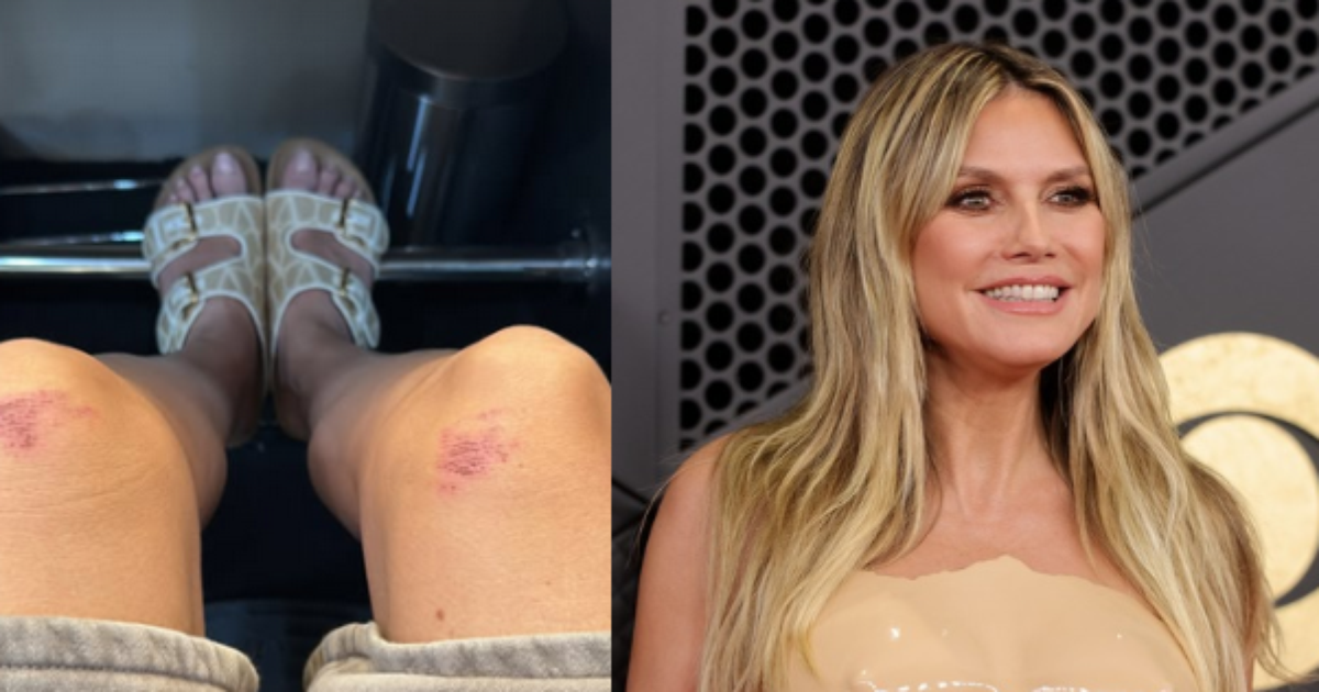 Heidi mostrou os joelhos machucados por roupa que usou no Grammy 2026 Foto: Montagem: Reproduçã...